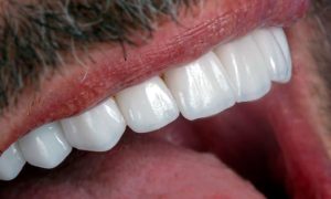Dra-Ester-Abrantes-Lentes-Dentes-Odontologia-Estética-10