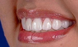 Dra-Ester-Abrantes-Lentes-Dentes-Odontologia-Estética-11