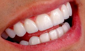 Dra-Ester-Abrantes-Lentes-Dentes-Odontologia-Estética-3