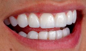 Dra-Ester-Abrantes-Lentes-Dentes-Odontologia-Estética-4