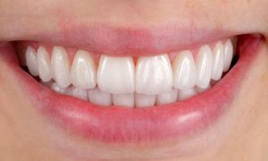 Dra-Ester-Abrantes-Lentes-Dentes-Odontologia-Estética-6