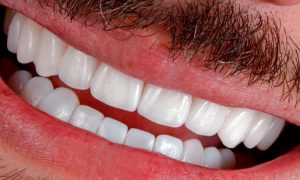Dra-Ester-Abrantes-Lentes-Dentes-Odontologia-Estética-7