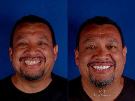 Lentes-de-resina-dentes-dra-ester2